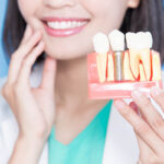 Dental Implants in Marathahalli: Types, Procedure, Cost & Benefits