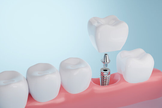Dental Implants: A Permanent Solution To Missing Teeth