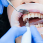 Teeth Cleaning in Panvel: A Complete Guide to Healthy Teeth and Strong Gums