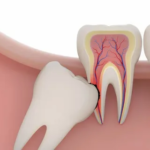 Wisdom Tooth Removal in Rajajinagar Bangalore: Safe, Comfortable & Expert Care