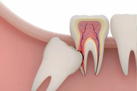 Wisdom Tooth Removal in Rajajinagar Bangalore: Safe, Comfortable & Expert Care
