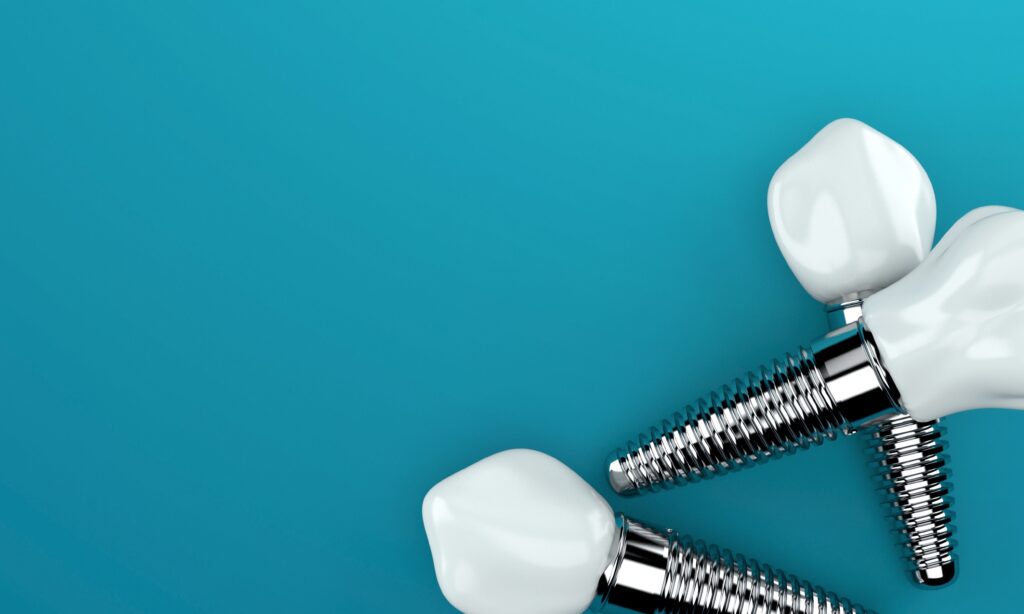 A New Chapter for Your Smile with Dental Implants