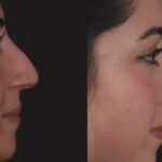Nose Deviated Septum Surgery in Dubai: Airway Evaluation