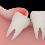 Why a Tooth Extraction May Be Necessary Even If You Feel No Pain