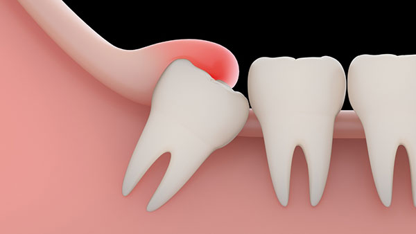 Why a Tooth Extraction May Be Necessary Even If You Feel No Pain