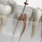 Saving Your Natural Smile with Root Canal Treatment in Bhandara