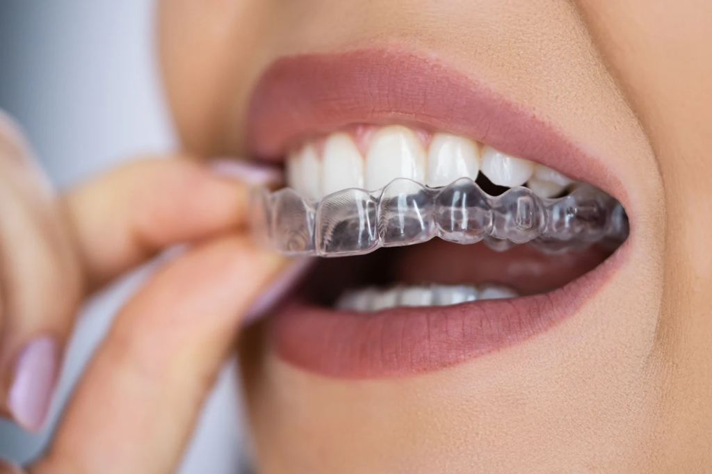 Invisalign Aligner in Kolhapur: The Clear Path to a Confident Smile