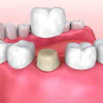 Is a Dental Crown Really Necessary? 7 Signs You Shouldn’t Ignore