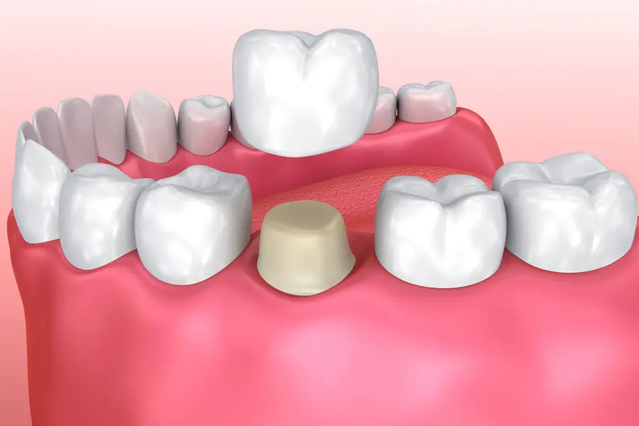 Is a Dental Crown Really Necessary? 7 Signs You Shouldn’t Ignore