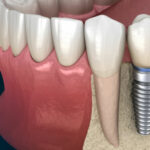 Discover The Types of Dental Implants -Find Your Right Fit
