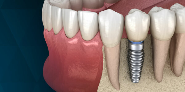 Discover The Types of Dental Implants -Find Your Right Fit