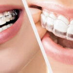 Braces Treatment Age Limit: What Is the Right Age to Get Braces?