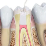 Best Root Canal Treatment in Gota Ahmedabad