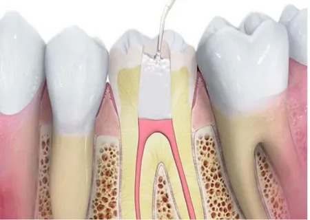Best Root Canal Treatment in Gota Ahmedabad