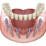 All-on-6 Implant in Nashik: Cost, Procedure, and Recovery Timeline Explained
