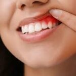 Effective Gum Treatment in Kandivali for Healthy and Strong Gums
