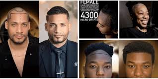 Hair Transplant Turkey: Complete Guide for International Patients