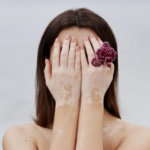 Vitiligo and Autoimmune Disorders: A Homeopathic Treatment Perspective