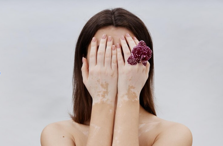 Vitiligo and Autoimmune Disorders: A Homeopathic Treatment Perspective