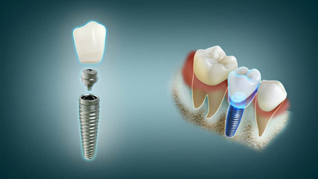 Dental Implants Cost, Procedure & Recovery: Everything You Need to Know Before Getting One
