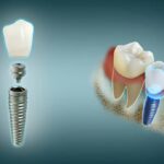 Dental Implants Cost, Procedure & Recovery: Everything You Need to Know Before Getting One