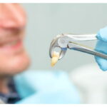 Tooth Extraction: What To Expect Before And After