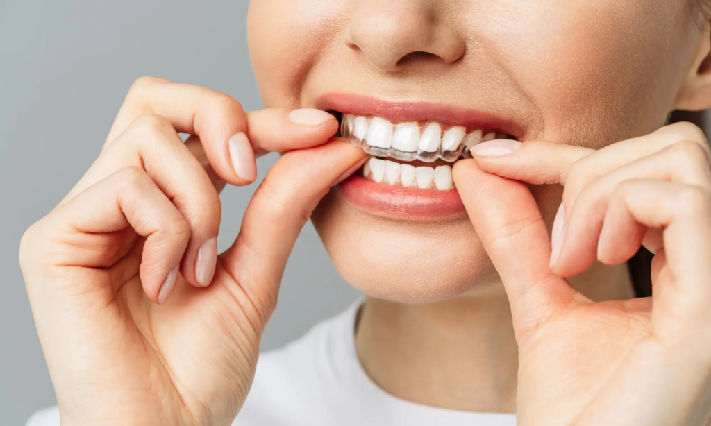 Modern Smile Correction: Understanding Clear Aligners Treatment in Fatima Nagar, Wanowrie