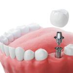 Can Dental Implants Fix Multiple Missing Teeth?