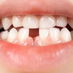 Missing Teeth Treatment in Panvel: Restore Your Complete Smile