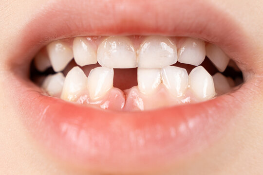 Missing Teeth Treatment in Panvel: Restore Your Complete Smile