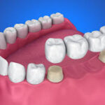 Complete Guide to Crown and Bridges Treatment for a Stronger Smile