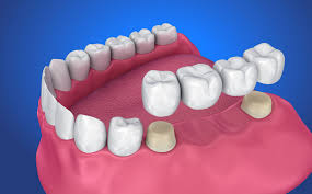 Complete Guide to Crown and Bridges Treatment for a Stronger Smile