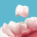 How Do You Know If You Need Dental Crowns Treatment in Seawoods?