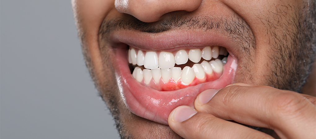 Pregnancy and Bleeding Gums: Symptoms, Treatment & How to Protect Your Smile