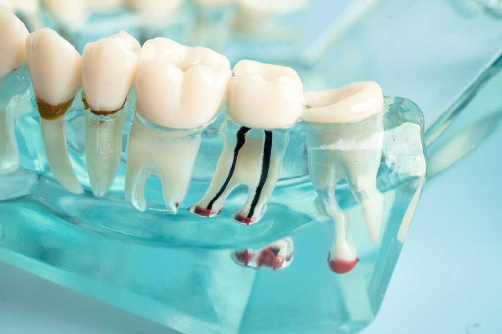 Root Canal Treatment for Infection Control and Prevention