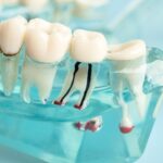 Root Canal Treatment for Infection Control and Prevention