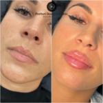 Juvederm Results Timeline Explained by the Best Aesthetic Clinics in Dubai