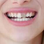 How to Remove Dark Marks on Teeth for a Brighter, Confident Smile