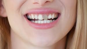 How to Remove Dark Marks on Teeth for a Brighter, Confident Smile