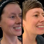 How Do Best Plastic Surgeons in Dubai Ensure Profhilo Safety?