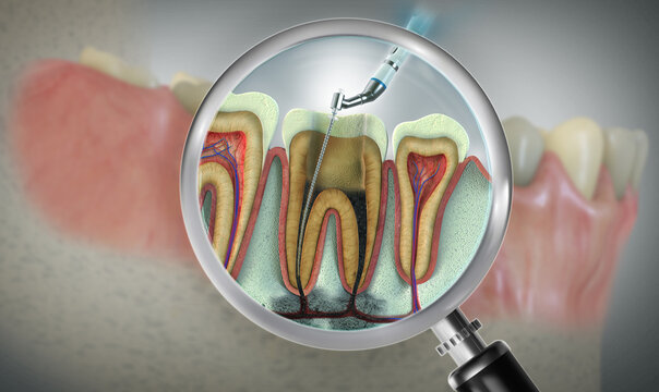What Happens If You Delay Root Canal Treatment?