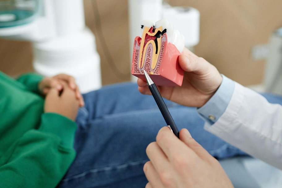 Root Canal Recovery Timeline: When Can You Start Eating Solid Food?