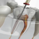 Laser Dentistry: Painless and Advanced Dental Care in Hinjewadi