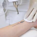 Tattoo Removal in Lahore: Modern Laser Solutions