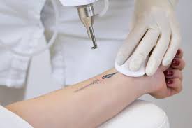 Tattoo Removal in Lahore: Modern Laser Solutions