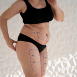 Liposuction vs Non-Surgical Fat Reduction: Which Is Better?