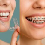 Braces Treatment Timeline: How Long Does Orthodontic Treatment Really Take?