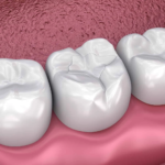 Restoring Your Smile Naturally with Tooth Coloured Filling in Parel Mumbai