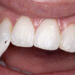 Why Dentists Recommend Dental Fluoride Treatment in Ravet for Cavity Prevention