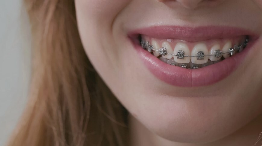 How Braces Treatment Improves More Than Just Your Smile